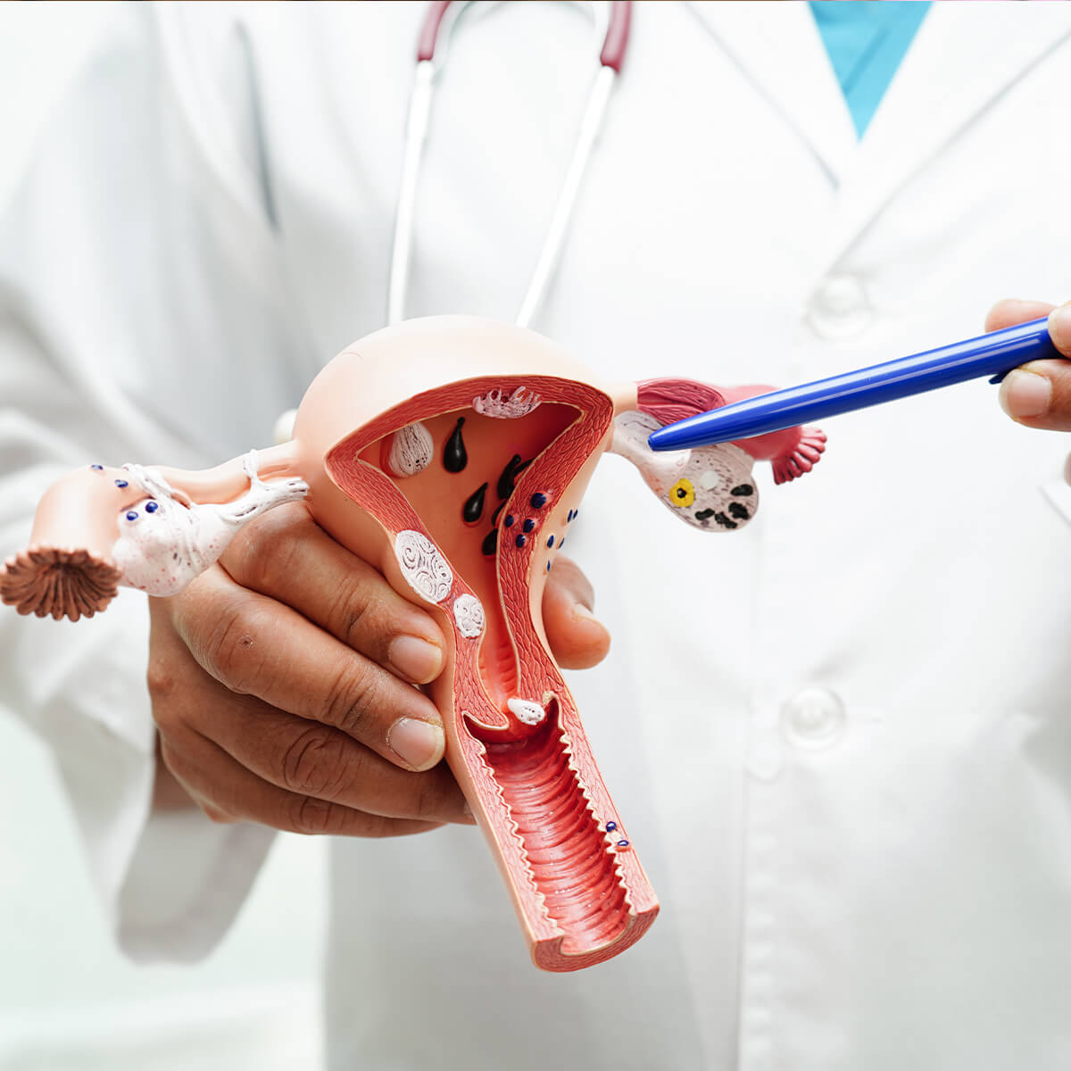 Cervical Cancer Now Affecting Young Women Too – Know the Causes